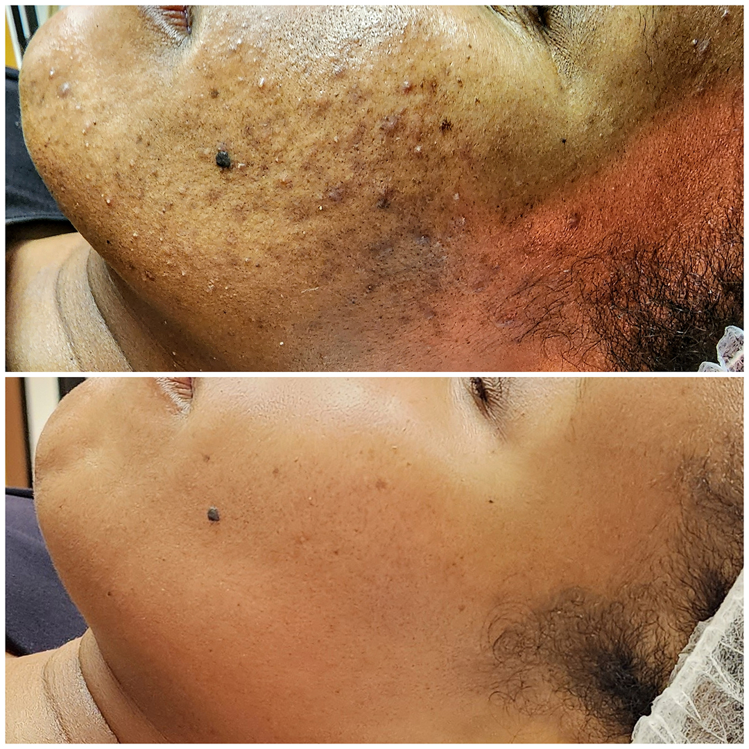 Acne and PIH