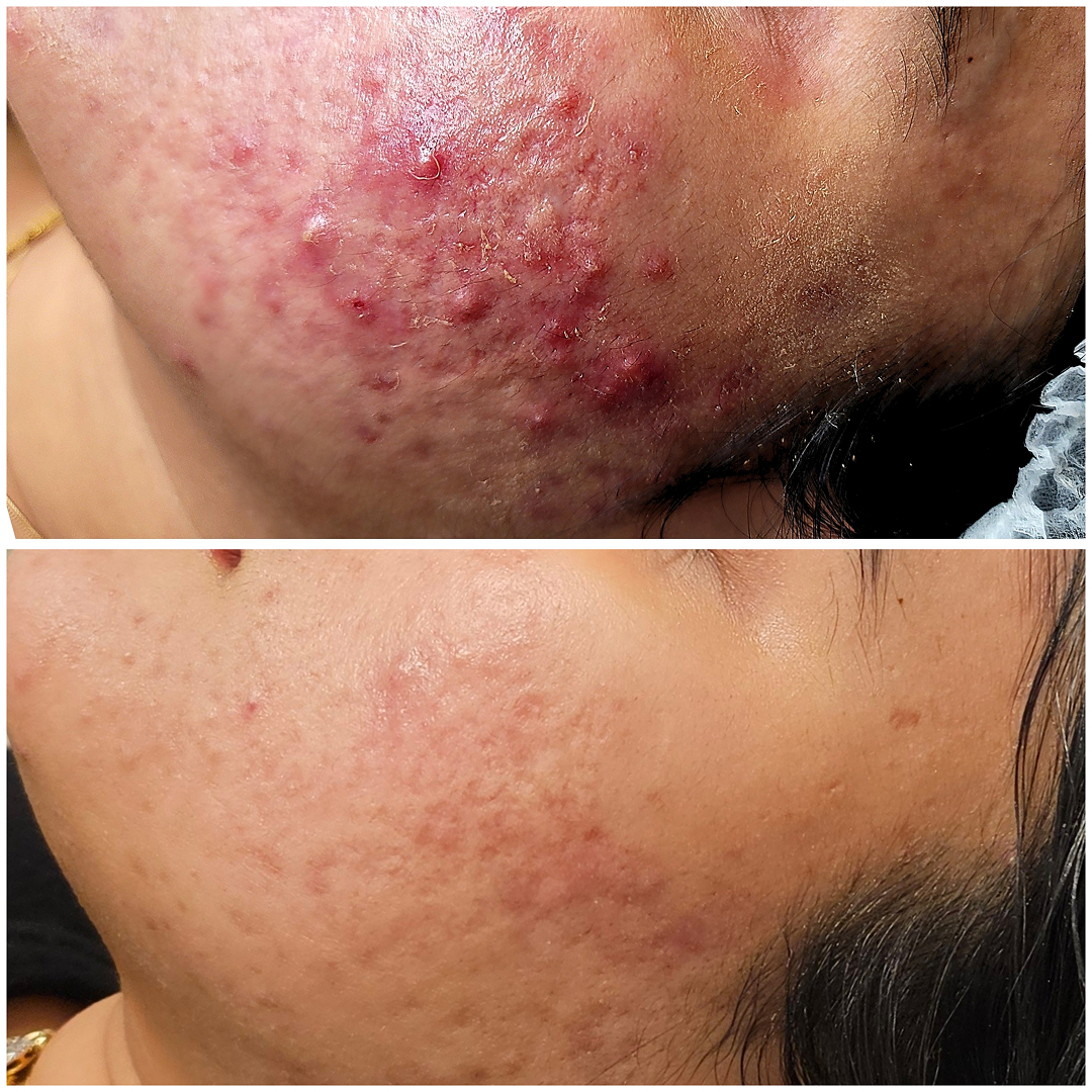 Hormonal acne