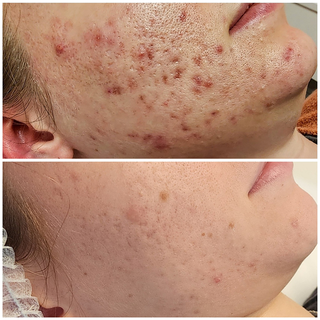 Red Acne Scars