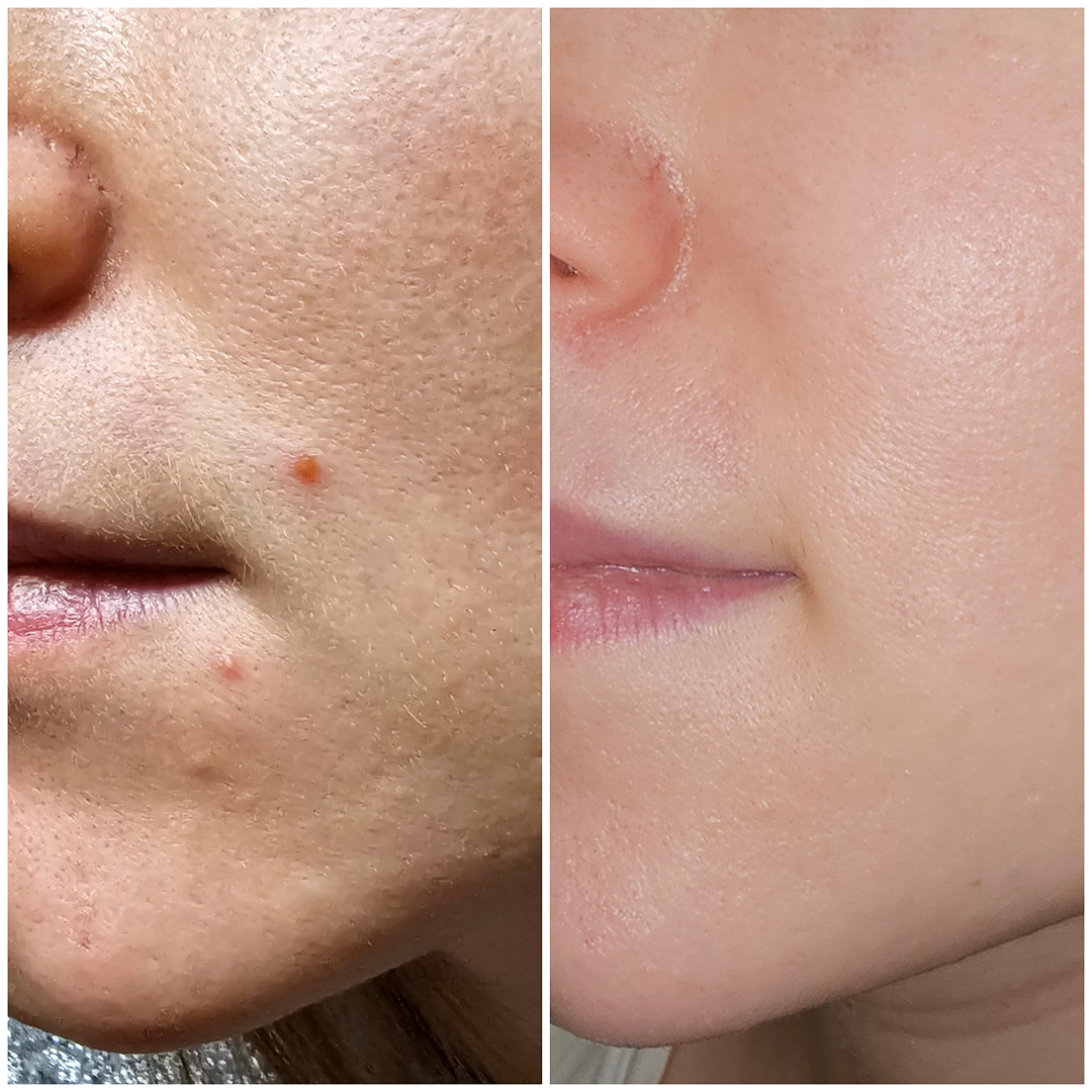 Acne Facial