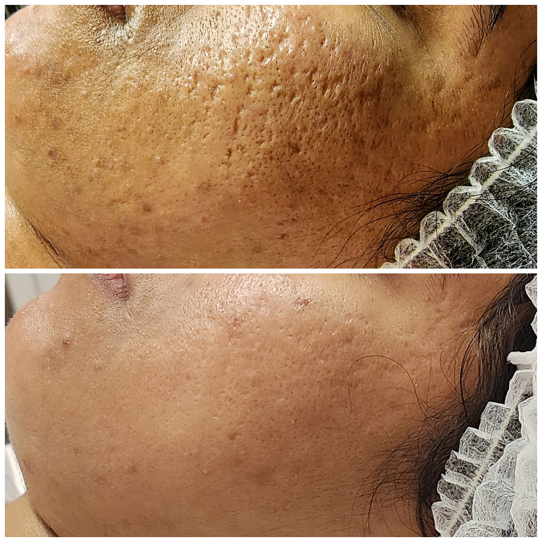 Acne scar treatment