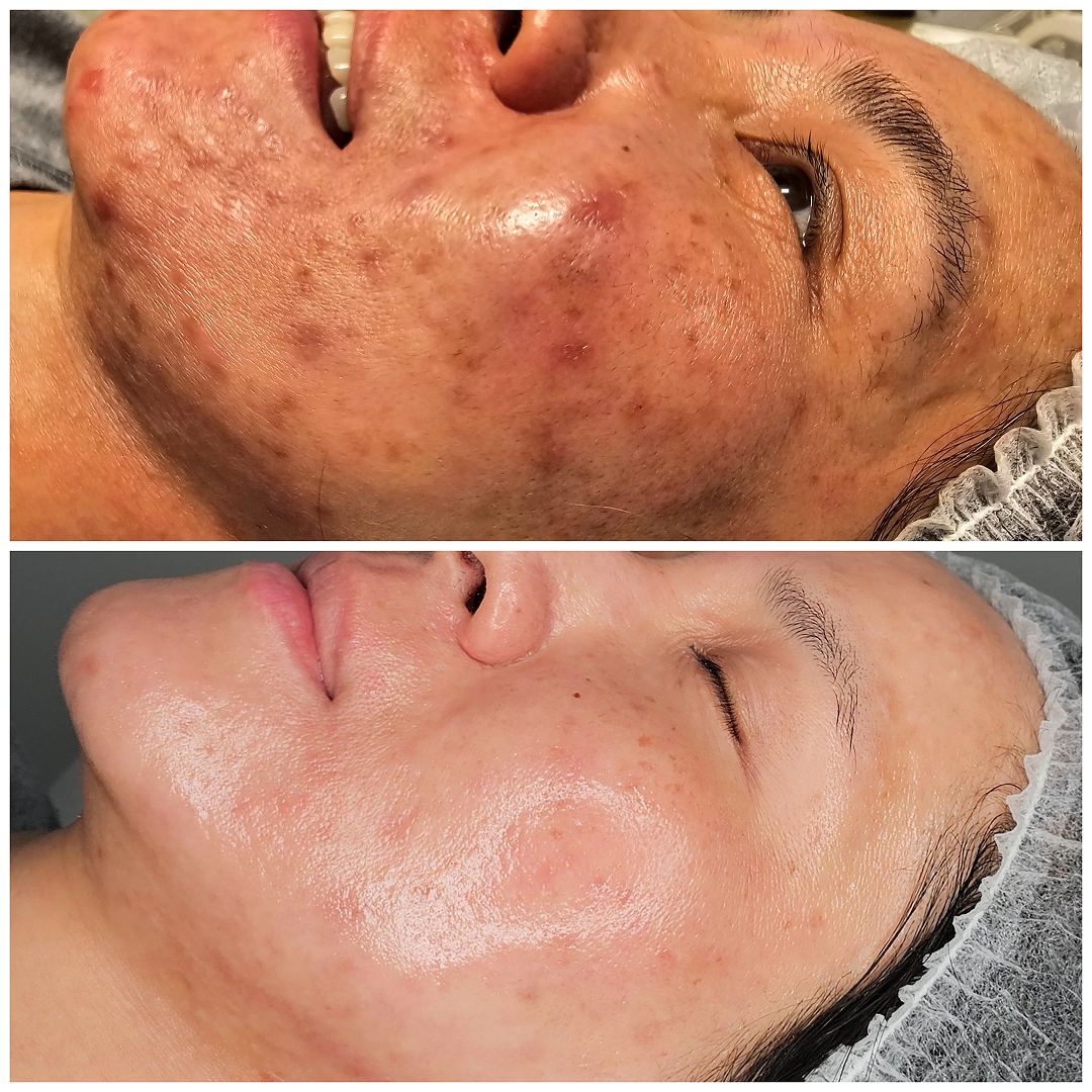 Acne to Glass skin