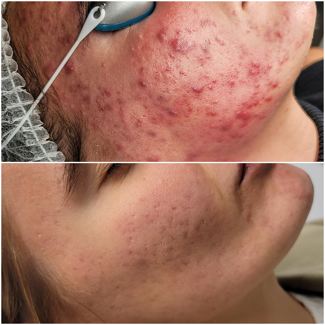 Acne Treatment