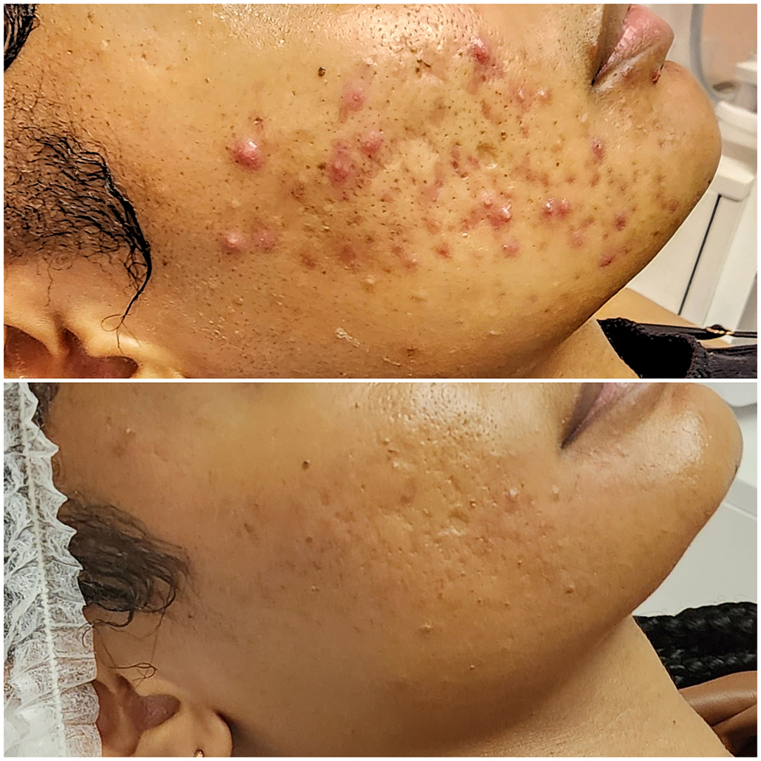 Clear skin facial